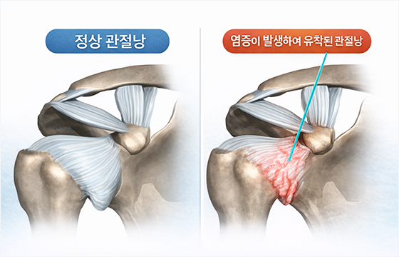 유착성 관절낭염